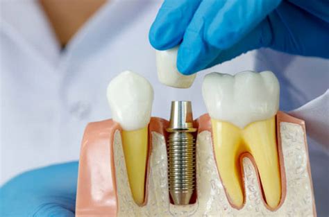 Dental Implants Near Me in Fort Washington, Pennsylvania